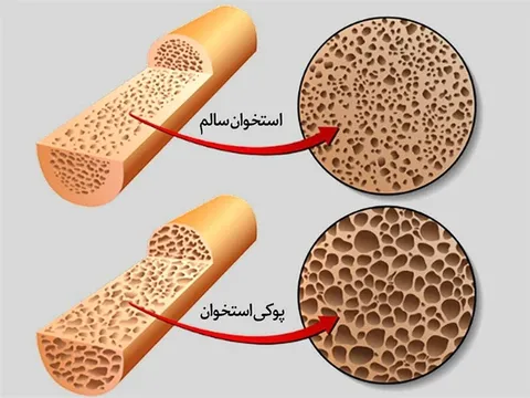 این خوراکی کوچک، دشمن بزرگ پوکی استخوان است