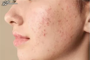 فیلم / نحوه رفع جای جوش صورت