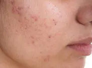 چرا حتی بعد از دوران نوجوانی هم جوش می‌زنید؟ متخصص پوست درباره آکنه بزرگسالی توضیح می‌دهد
